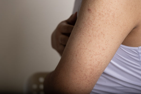 Keratosis Pilaris - Osmia