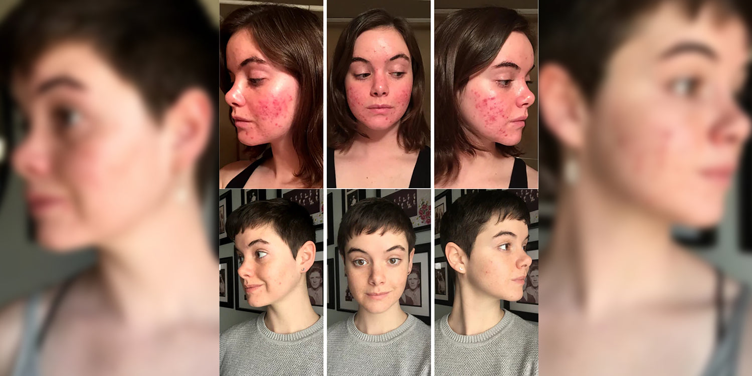 How I Healed My Acne Naturally