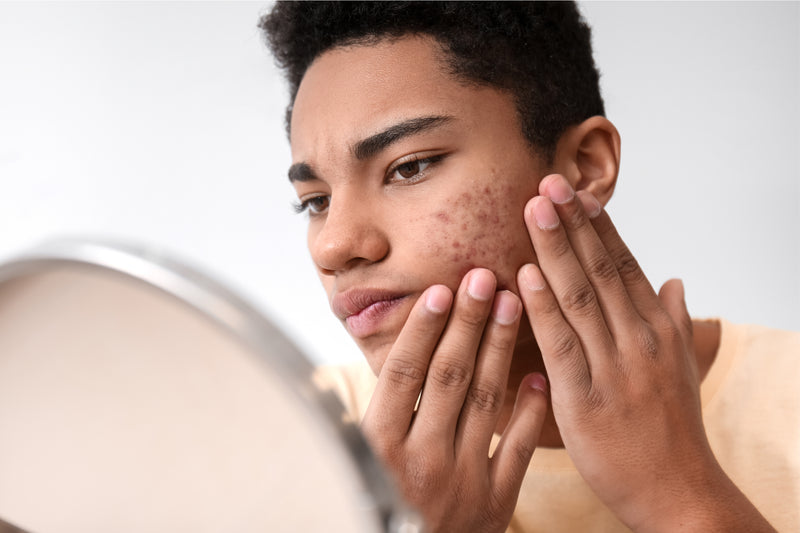 Skincare For Teens With Acne - Osmia