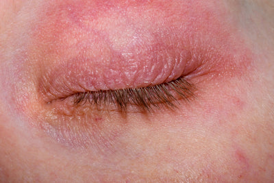 Close up of an eyelid showing redness and irritation