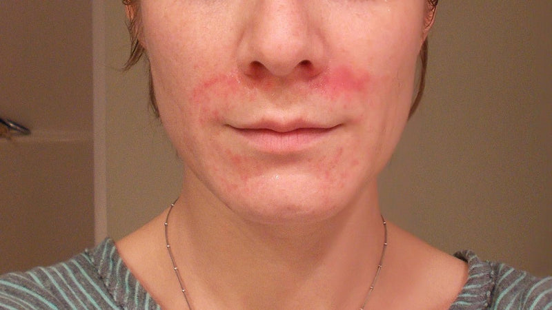 Perioral Dermatitis: A Physician’s Natural Treatment Approach - Osmia