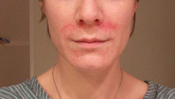 Perioral Dermatitis: A Physician’s Natural Treatment Approach - Osmia